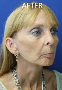 Mardirossian Facial Aesthetics Before and After Pictures
