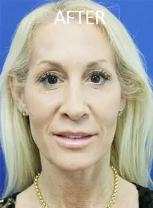 Mardirossian Facial Aesthetics Before and After Pictures