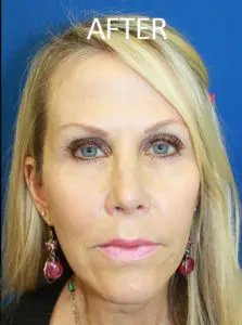 Mardirossian Facial Aesthetics Before and After Pictures
