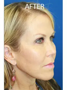 Mardirossian Facial Aesthetics Before and After Pictures