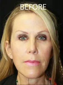 Mardirossian Facial Aesthetics Before and After Pictures