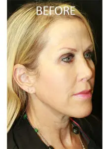 Mardirossian Facial Aesthetics Before and After Pictures