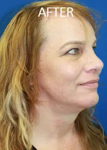 Mardirossian Facial Aesthetics Before and After Pictures