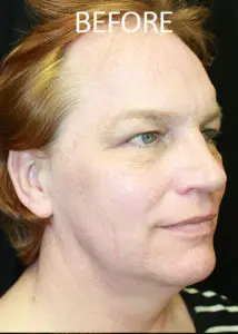 Mardirossian Facial Aesthetics Before and After Pictures