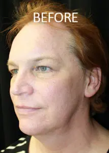 Mardirossian Facial Aesthetics Before and After Pictures