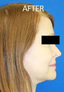 Mardirossian Facial Aesthetics Before and After Pictures