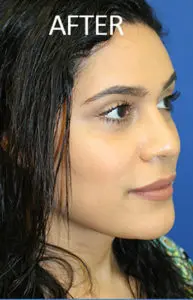 Mardirossian Facial Aesthetics Before and After Pictures