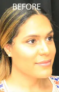 Mardirossian Facial Aesthetics Before and After Pictures