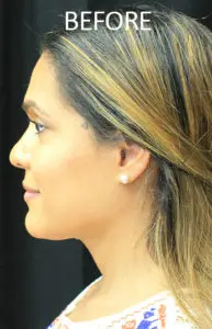 Mardirossian Facial Aesthetics Before and After Pictures