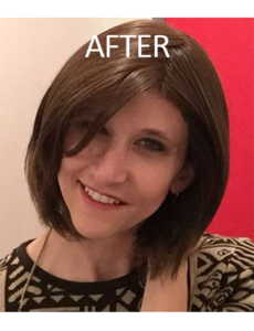 Mardirossian Facial Aesthetics Before and After Pictures