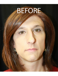 Mardirossian Facial Aesthetics Before and After Pictures