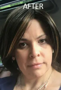 Mardirossian Facial Aesthetics Before and After Pictures