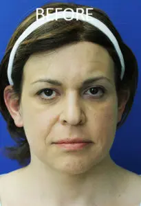 Mardirossian Facial Aesthetics Before and After Pictures