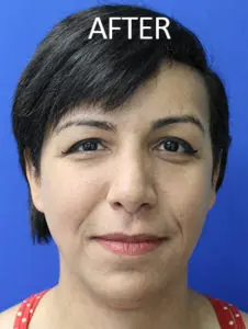 Mardirossian Facial Aesthetics Before and After Pictures