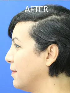 Mardirossian Facial Aesthetics Before and After Pictures