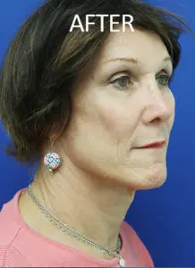 Mardirossian Facial Aesthetics Before and After Pictures