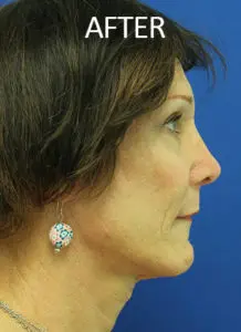 Mardirossian Facial Aesthetics Before and After Pictures
