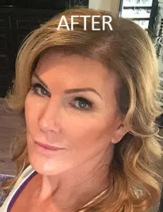 Mardirossian Facial Aesthetics Before and After Pictures