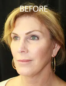 Mardirossian Facial Aesthetics Before and After Pictures
