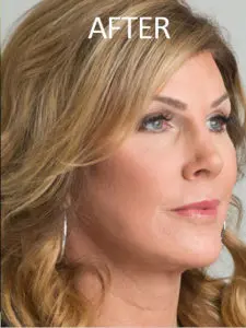 Mardirossian Facial Aesthetics Before and After Pictures