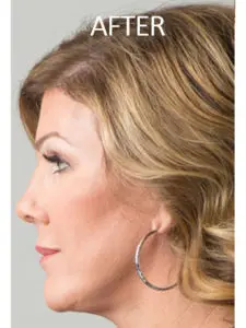 Mardirossian Facial Aesthetics Before and After Pictures