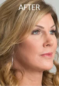 Mardirossian Facial Aesthetics Before and After Pictures