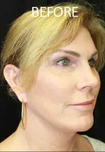 Mardirossian Facial Aesthetics Before and After Pictures