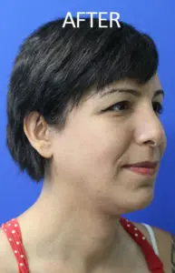 Mardirossian Facial Aesthetics Before and After Pictures