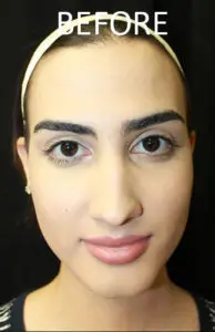 Mardirossian Facial Aesthetics Before and After Pictures