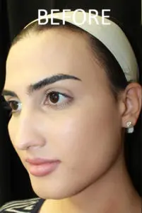 Mardirossian Facial Aesthetics Before and After Pictures