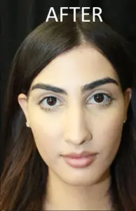 Mardirossian Facial Aesthetics Before and After Pictures