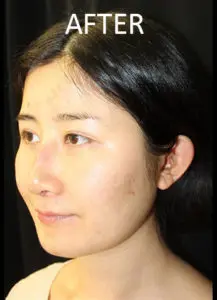 Mardirossian Facial Aesthetics Before and After Pictures