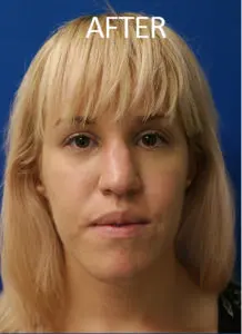 Mardirossian Facial Aesthetics Before and After Pictures