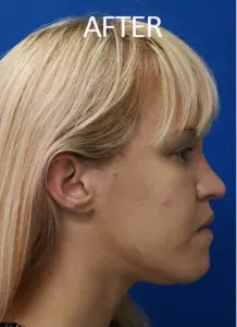 Mardirossian Facial Aesthetics Before and After Pictures