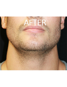 Mardirossian Facial Aesthetics Before and After Pictures