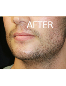 Mardirossian Facial Aesthetics Before and After Pictures