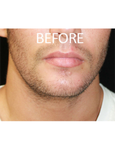 Mardirossian Facial Aesthetics Before and After Pictures
