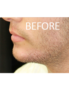 Mardirossian Facial Aesthetics Before and After Pictures