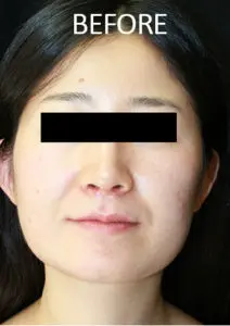 Mardirossian Facial Aesthetics Before and After Pictures