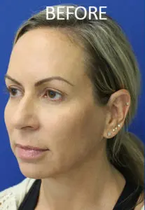 Mardirossian Facial Aesthetics Before and After Pictures