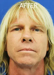 Mardirossian Facial Aesthetics Before and After Pictures