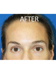 Mardirossian Facial Aesthetics Before and After Pictures