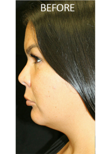 Mardirossian Facial Aesthetics Before and After Pictures