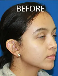Mardirossian Facial Aesthetics Before and After Pictures