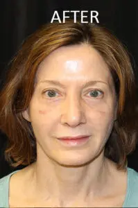 Mardirossian Facial Aesthetics Before and After Pictures