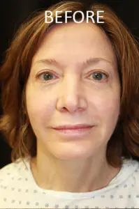 Mardirossian Facial Aesthetics Before and After Pictures