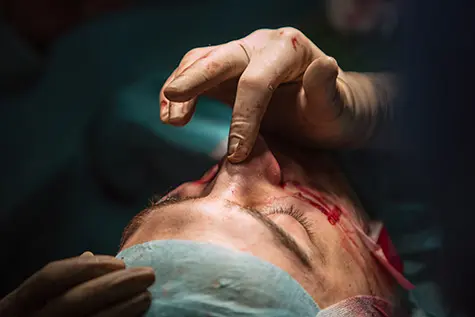 Rhinoplasty Questions