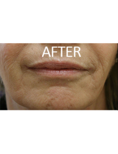 Mardirossian Facial Aesthetics Before and After Pictures