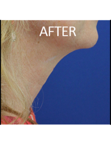 Mardirossian Facial Aesthetics Before and After Pictures