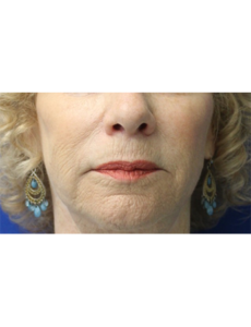 Mardirossian Facial Aesthetics Before and After Pictures